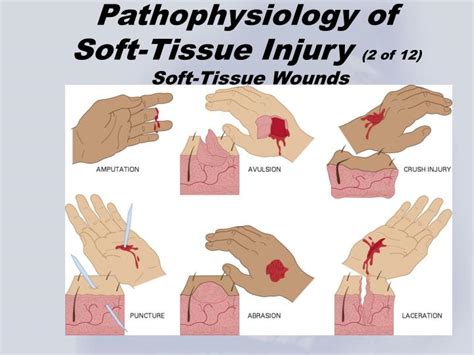 how to test for soft tissue damage|soft tissue injury symptoms.